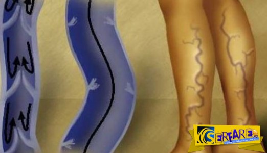 Φλεβίτιδα: Tips για να απαλλαγείτε μια και έξω!