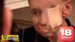 Δείτε τον άντρα που έχασε το μισό του πρόσωπο από καρκινο στη μύτη (+18)