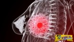 Καρκίνος μαστού: Η αφαίρεση περισσότερου ιστού μειώνει τον κίνδυνο δεύτερης επέμβασης!