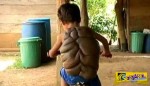 Σοκαριστικές εικόνες: Δείτε πως είναι το παιδί – χελώνα μετά την αφαίρεση του όγκου - καβούκι!