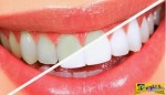 Πλάκα στα δόντια: Πώς θα απαλλαγείτε χωρίς επίσκεψη στον οδοντίατρο