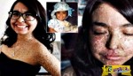 To κορίτσι με το σπάνιο σύνδρομο του βρυκόλακα: Η φρικτή πάθηση που της έχει καταστρέψει τη ζωή