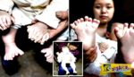 Μωρό στην Κίνα γεννήθηκε με 15 δάχτυλα στα χέρια και 16 στα πόδια!