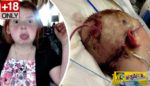 Ξεριζώθηκε το scalp 11χρονης όταν πιάστηκαν τα μαλλιά της σε τρενάκι λούνα παρκ!
