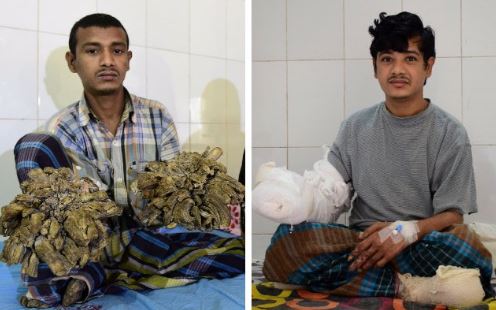 Πώς είναι σήμερα ο… άνθρωπος δέντρο μετά από 16 επεμβάσεις!