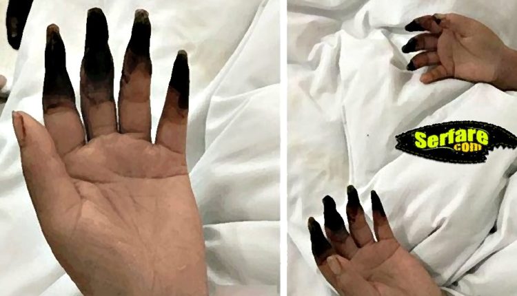 Τα δάχτυλα της Μαύρισαν μετά από δουλειές στο σπίτι! Διαβάστε την περίεργη ιστορία