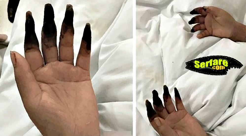 Τα δάχτυλα της Μαύρισαν μετά από δουλειές στο σπίτι! Διαβάστε την περίεργη ιστορία