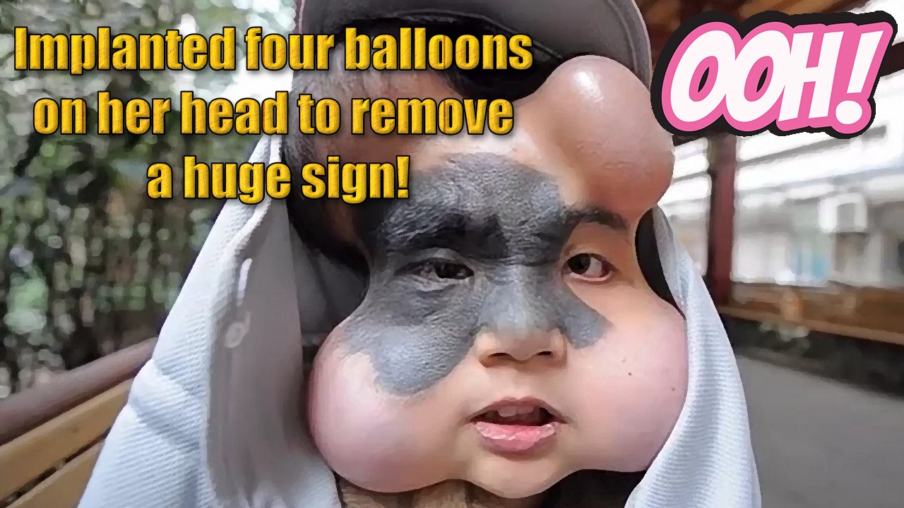 Εμφύτευσε τέσσερα μπαλόνια στο κεφάλι της για να αφαιρέσει ένα τεράστιο σημάδι!